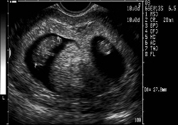 Tvillinger, sonogram