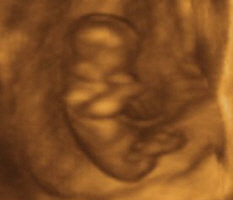 Elleve uger sonogram