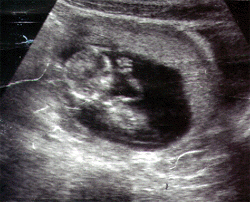 uge 12 sonogram