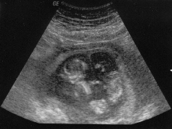 Tvillinger sonogram scanning