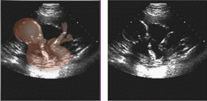 Ultralydsundersøgelse tidlig i graviditeten