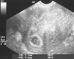 week6 ultrasound