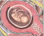 Normal foster i 11. graviditetsuge